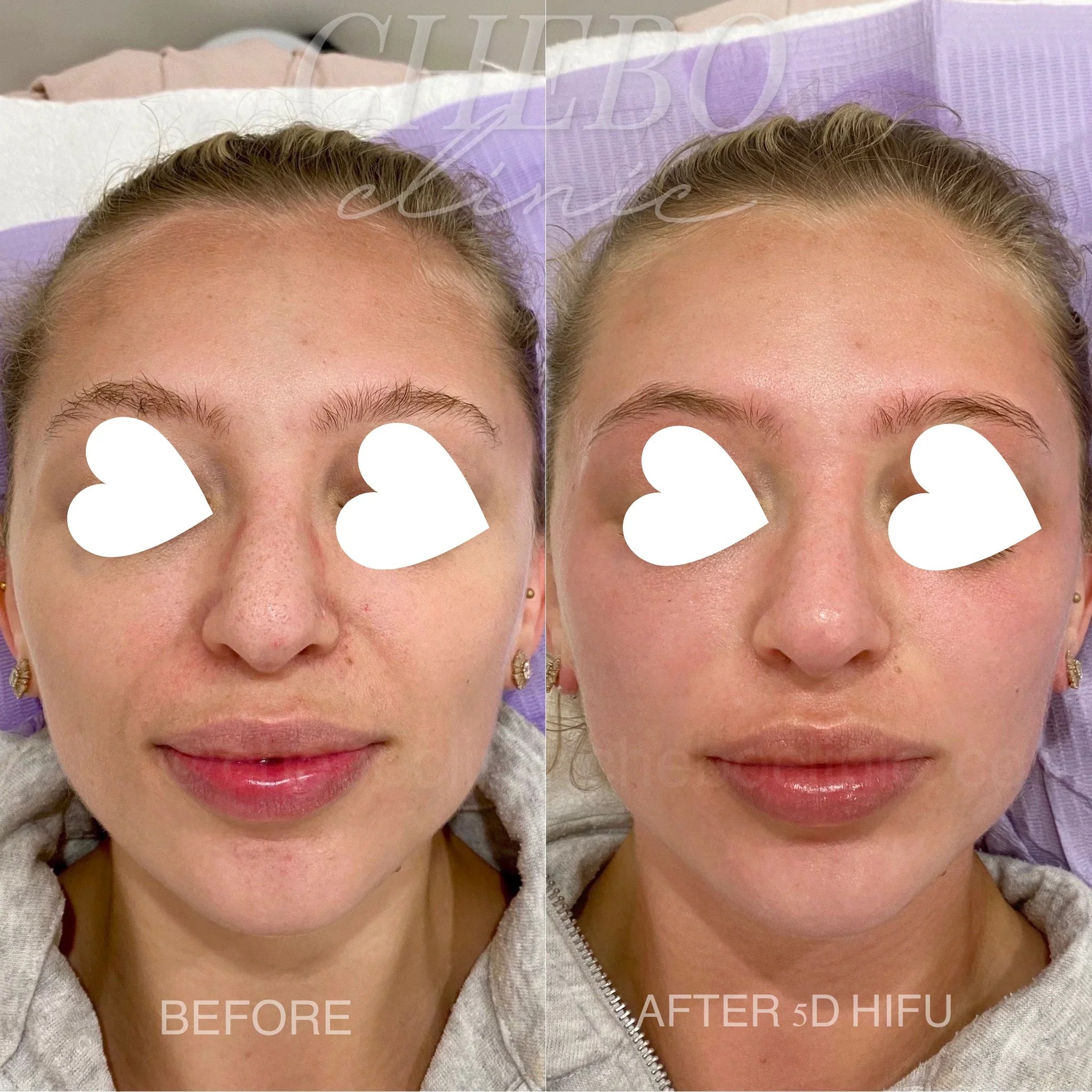 8D HIFU Skin Tightening Chebo Clinic