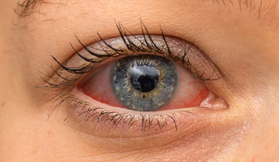 Symptoms of eye damage from solar eclipse Check Biotech