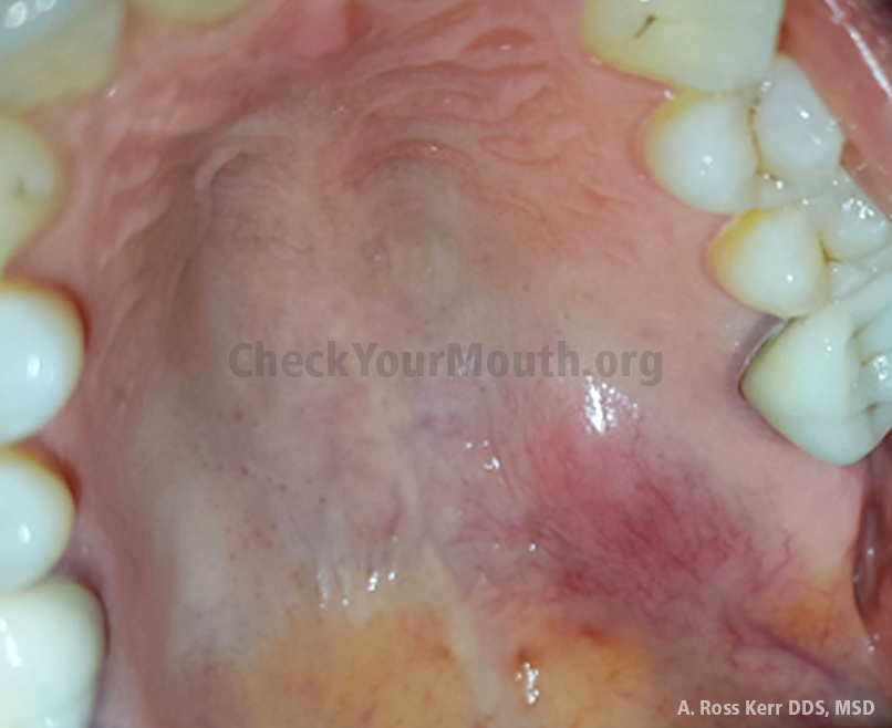 Roof of mouth, palate, incisive canals, lesser palatine foramina, greater, lesser palatine vessels, palatine raphe, incisive papilla, palatine aponeurosis, palatine muscles, levator veli palatini, tensor veli palatini, uvular muscle, palatoglossus muscle, palatopharyngeus muscle Introduction Check Your Mouth 2017