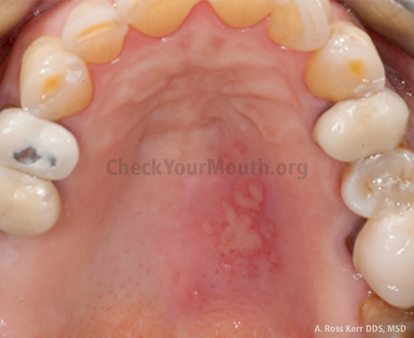 With sores and bumps on palate, you will need to have a dentist check it out as soon as possible, this is because it could be a sign of an underlying medical condition. Introduction Check Your Mouth 2017