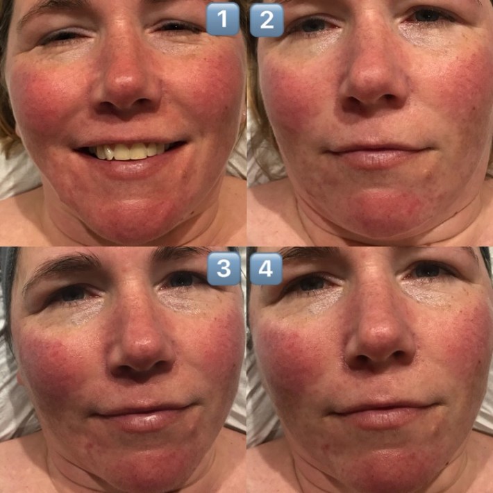 Ipl Or Laser For Rosacea