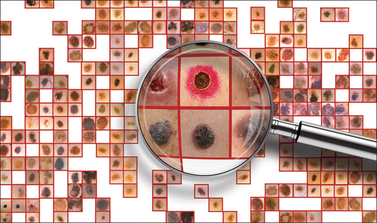 Skin Cancer AI Model