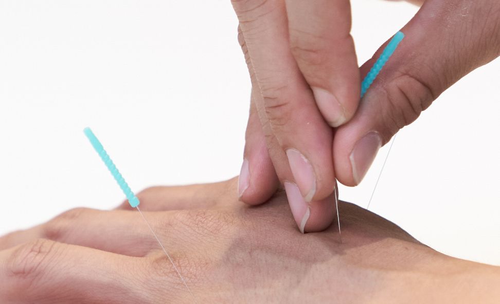 Acupuncture Cheng Acupuncture Wellness