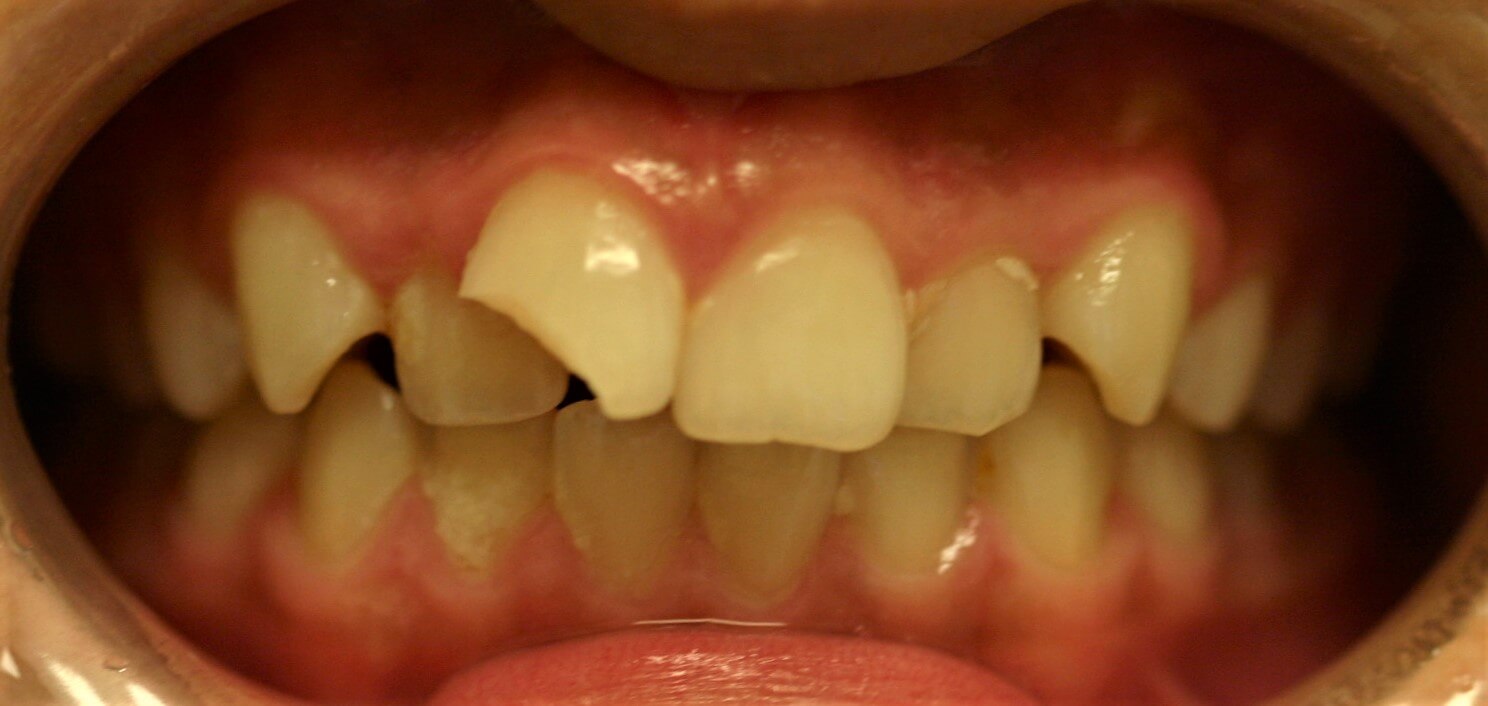 Before And After Braces