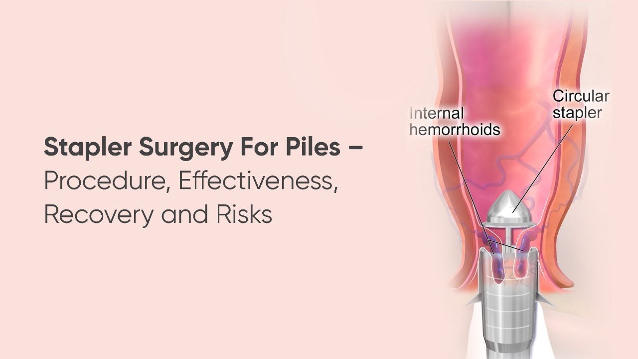Aggregate more than 153 rubber ring for piles latest awesomeenglish
