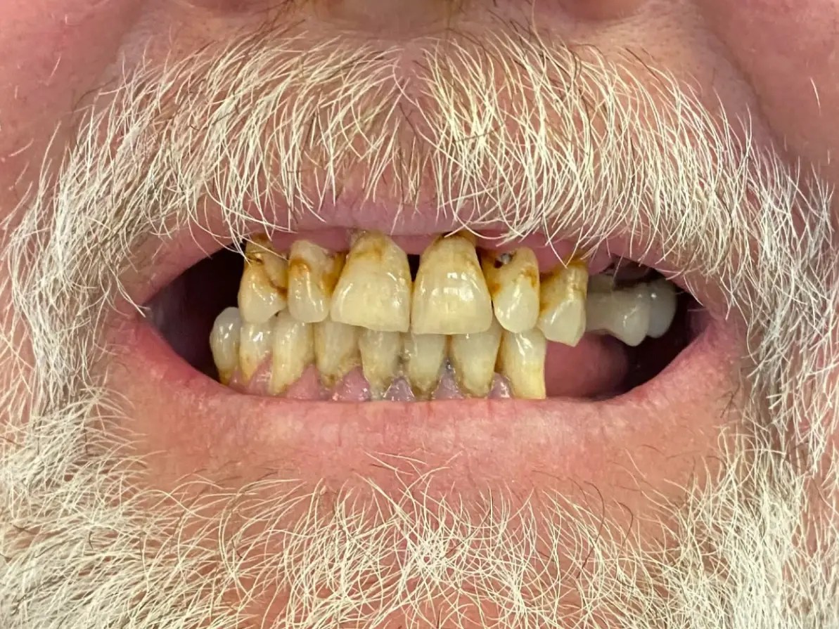 Dental Implants In Chesterton Sand Creek Dental