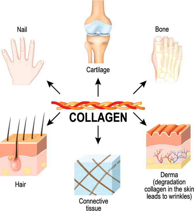 EhlersDanlos Syndrome(s) Connecting the Dots! Chiari Bridges