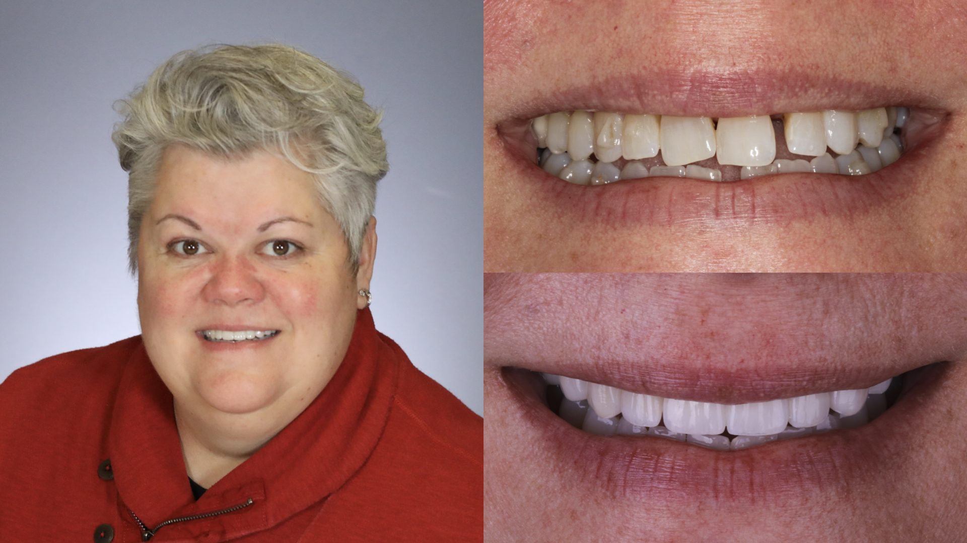 Dental Implants. Porcelain Crowns. Porcelain Veneers. Porcelain Bridge
