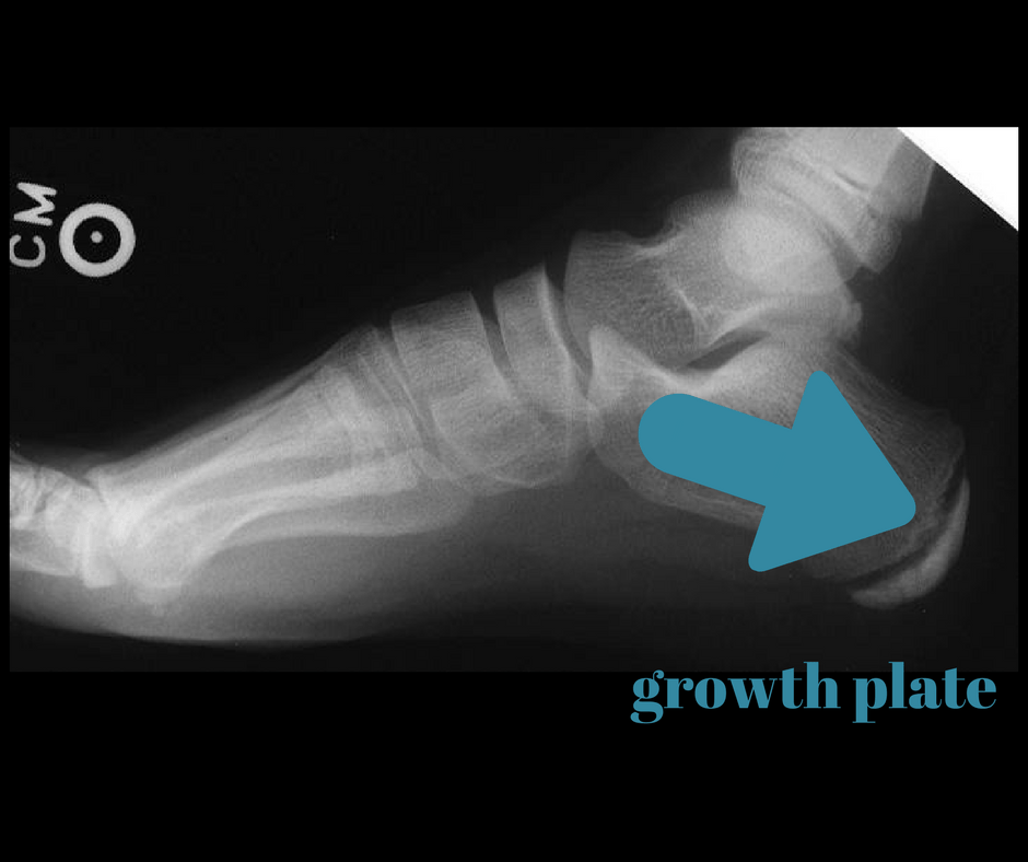 Sever’s Disease Chicago DPM