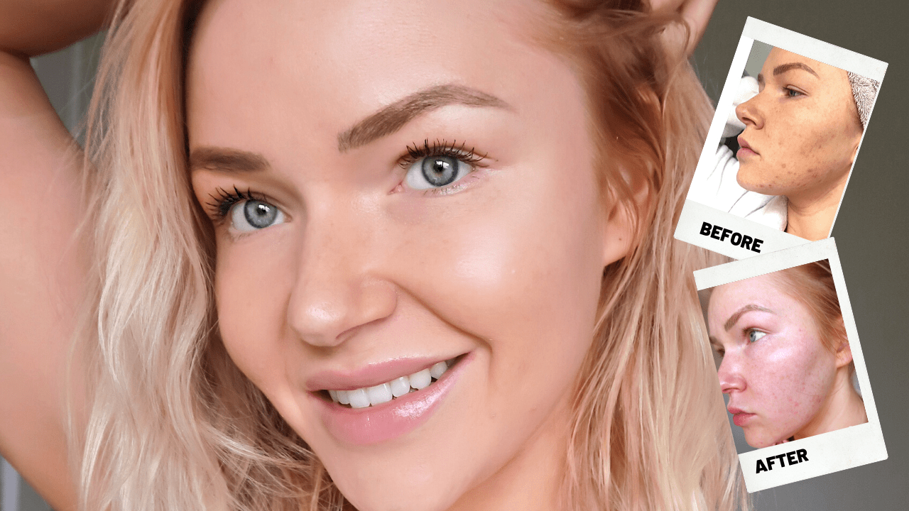 How I cured my adult acne Chic on the Run