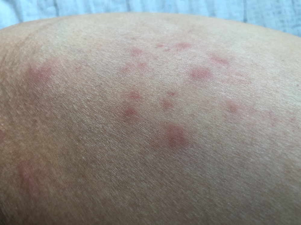 疥癬でしょうか？（画像あり） 数ヶ月ほど前に小指に一箇所ぷつっと水疱... Yahoo!知恵袋