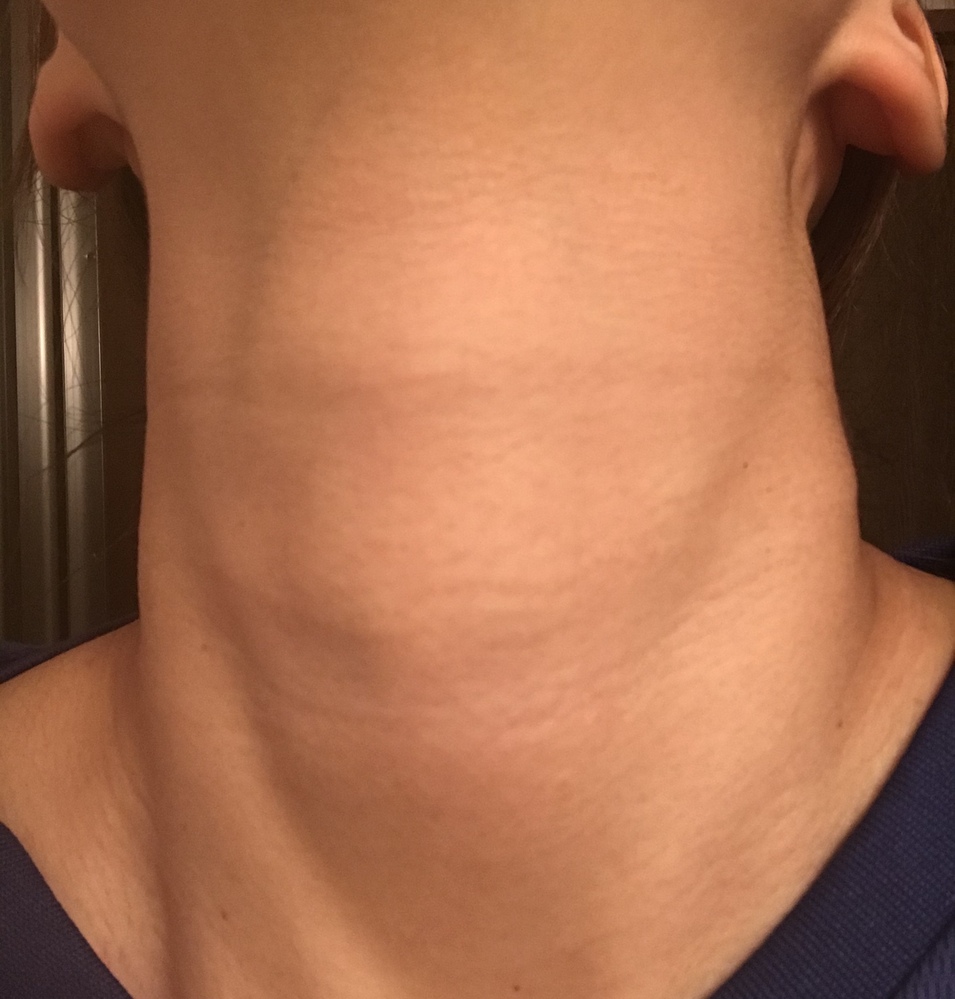 お見苦しい写真ですみません。これって甲状腺腫れてますか？？ 腫れてる... Yahoo!知恵袋