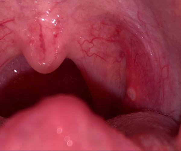 喉にできもの、違和感。注）画像有り 喉に違和感を感じ、見てみたら赤いで... Yahoo!知恵袋