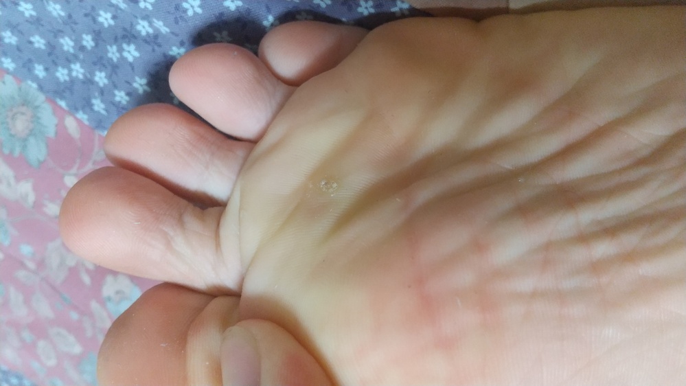 これは魚の目かミルメシアどちらでしょうか、再発したのですが ウィルス性... Yahoo!知恵袋