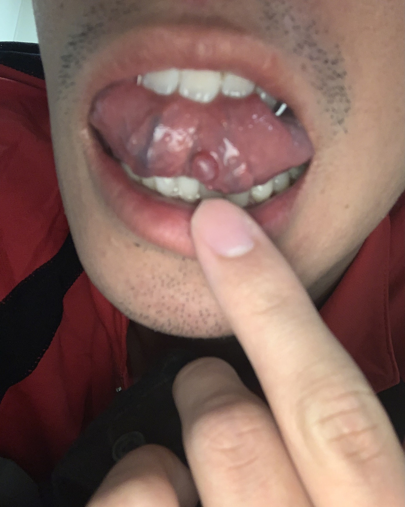 舌の裏に口内炎ができてすごい痛い。どうすれば治りますか？ Yahoo!知恵袋