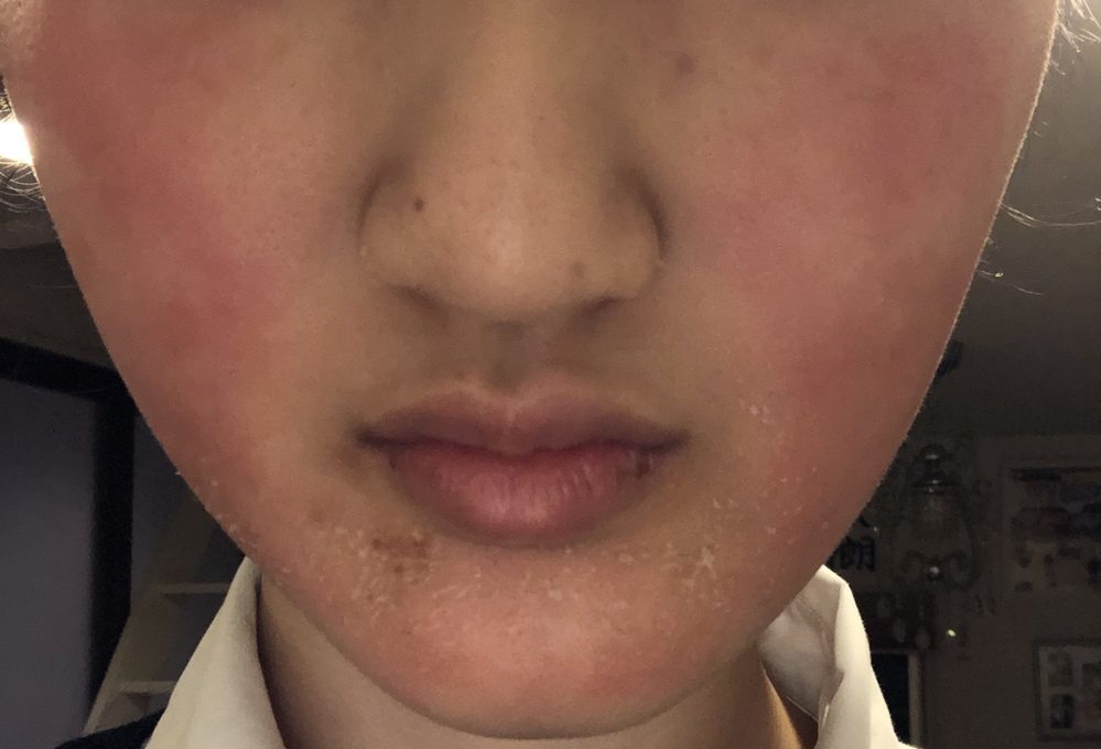 エピデュオゲルやディフェリンゲル、べピオゲルの使い方について質問です。... Yahoo!知恵袋