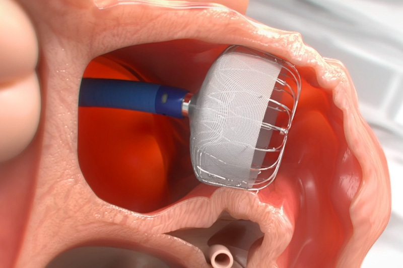 WATCHMAN 近森病院