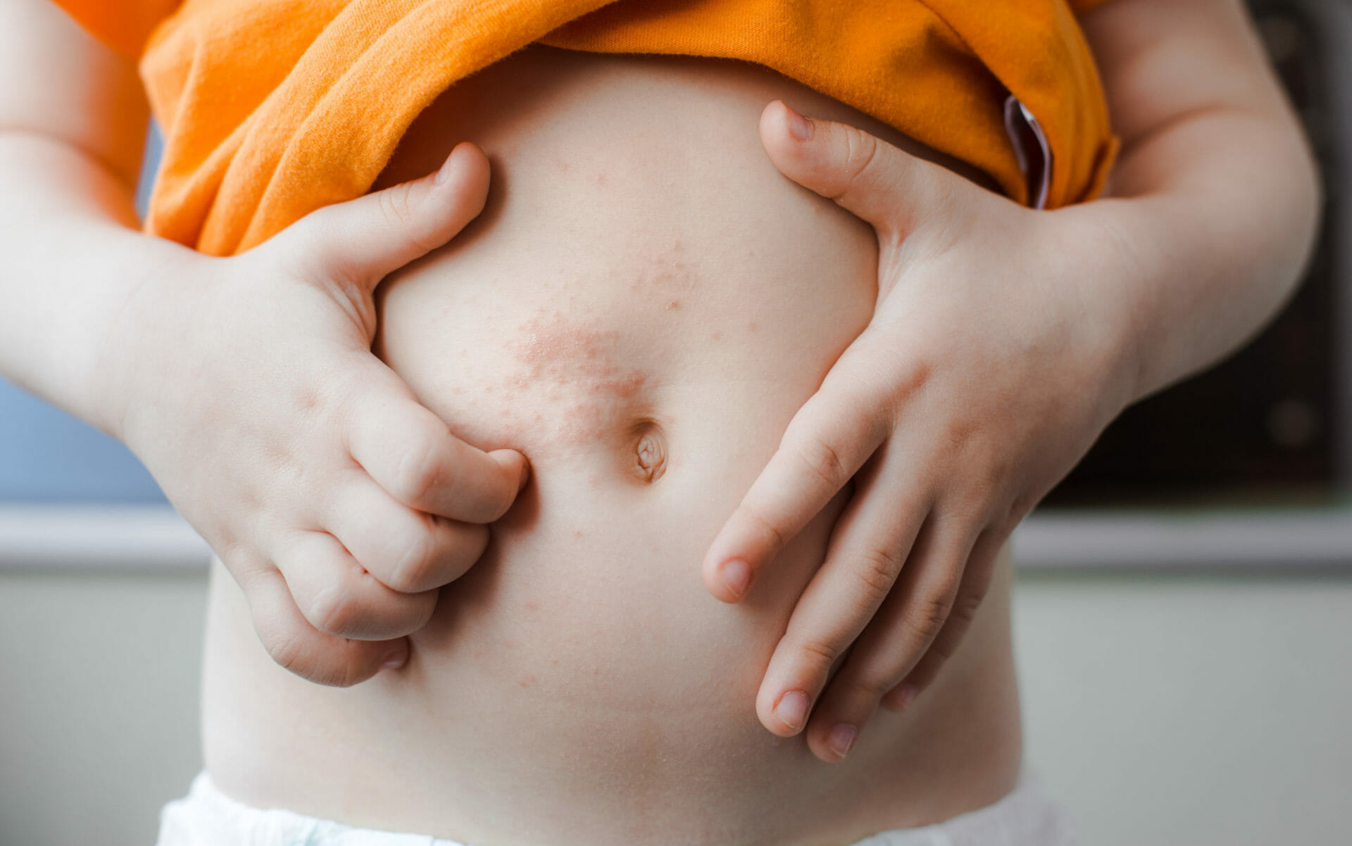 Chickenpox Vaccine For Children Childhealthy London