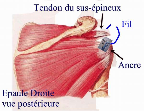 Rupture de la Coiffe des Rotateurs