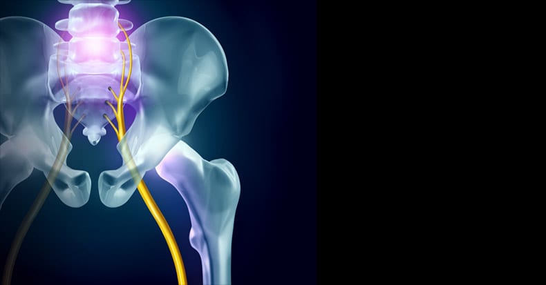 Deep Gluteal Syndrome What Is It?