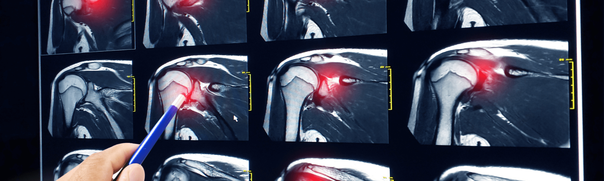 Chiropractic Care for Rotator Cuff Injury How it Can Help
