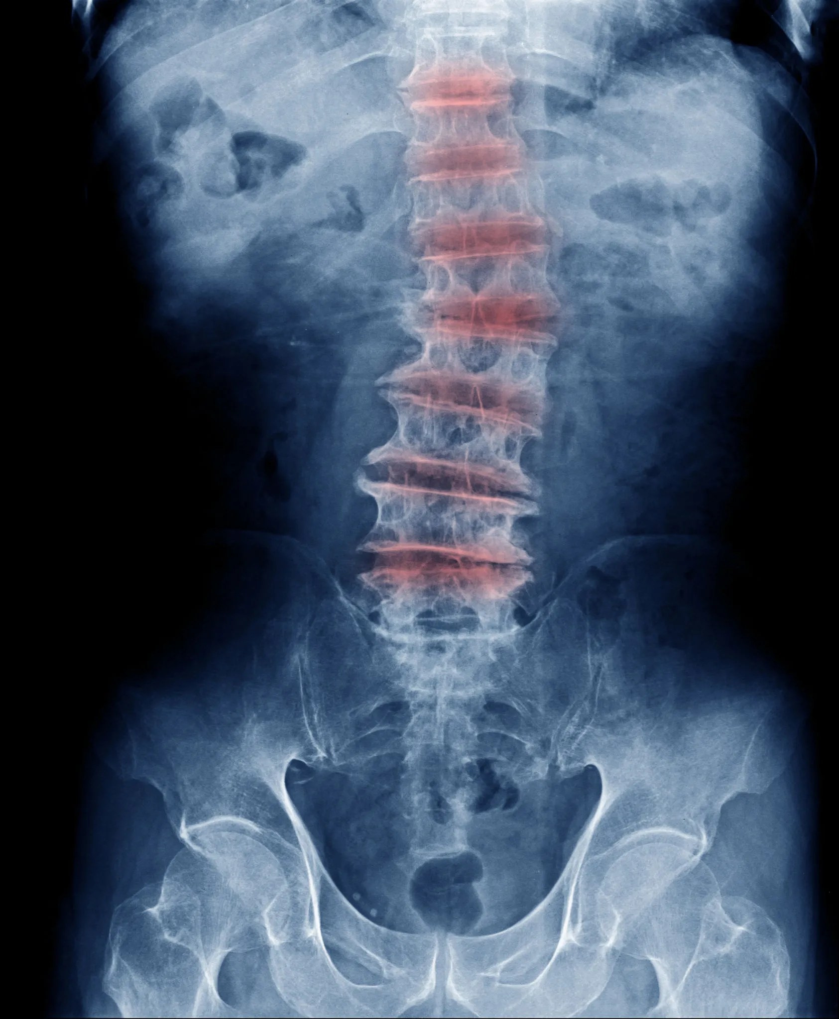 What Is Multilevel Degenerative Disc Disease? Chiropractor Richardson TX