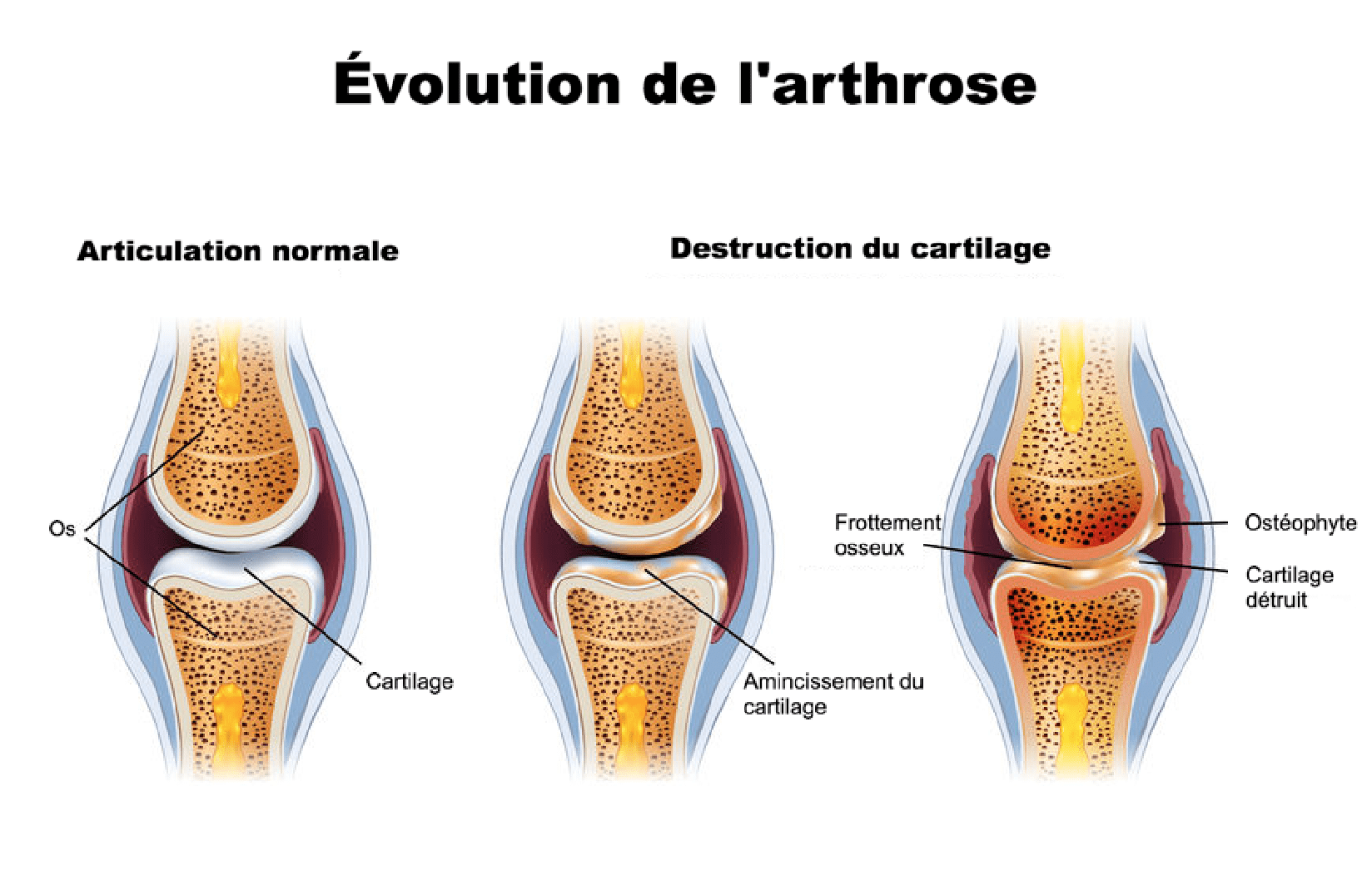 L'arthrose Causes, Symptômes, Prévention et Traitement de l'arthrose