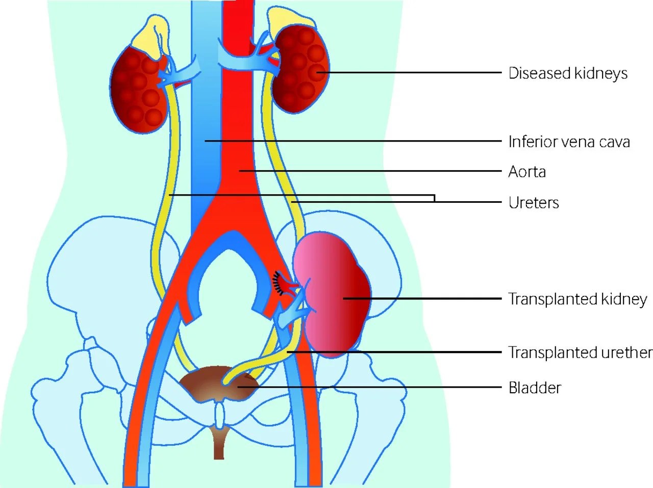 Programa de Evaluación de Trasplante Renal CHMT