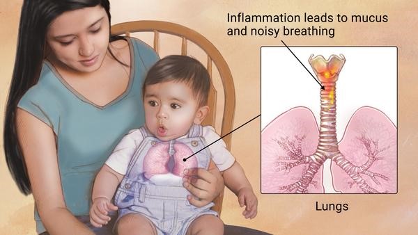Common Concerns: Croup - Altoona, Pa Pediatrician