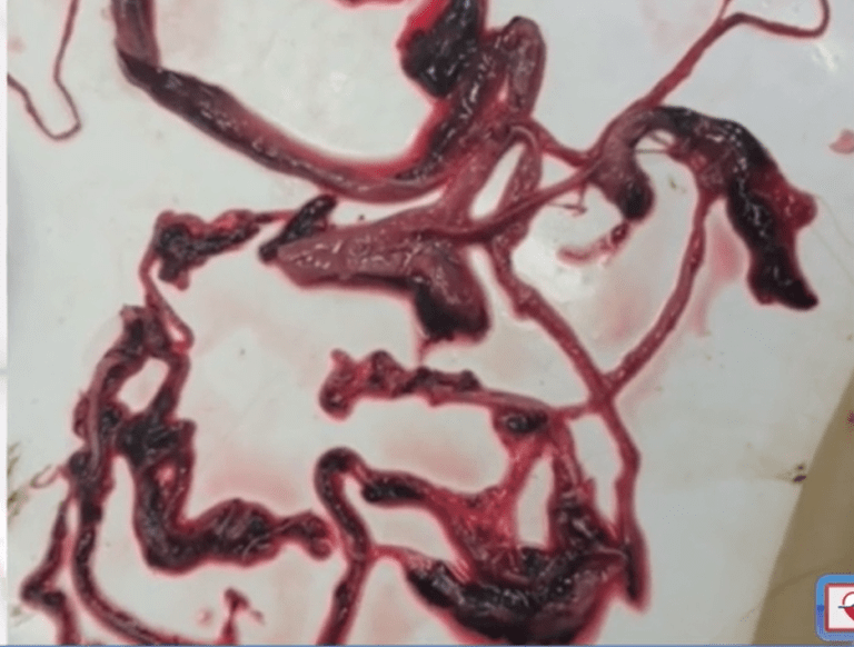 Long, Fibrous Blood Clots Found in Autopsies of the Vaxxed Christian