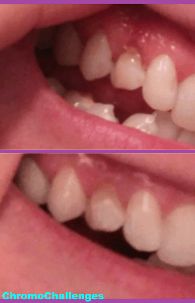 Tooth Remineralization Journey ChromoChallenges