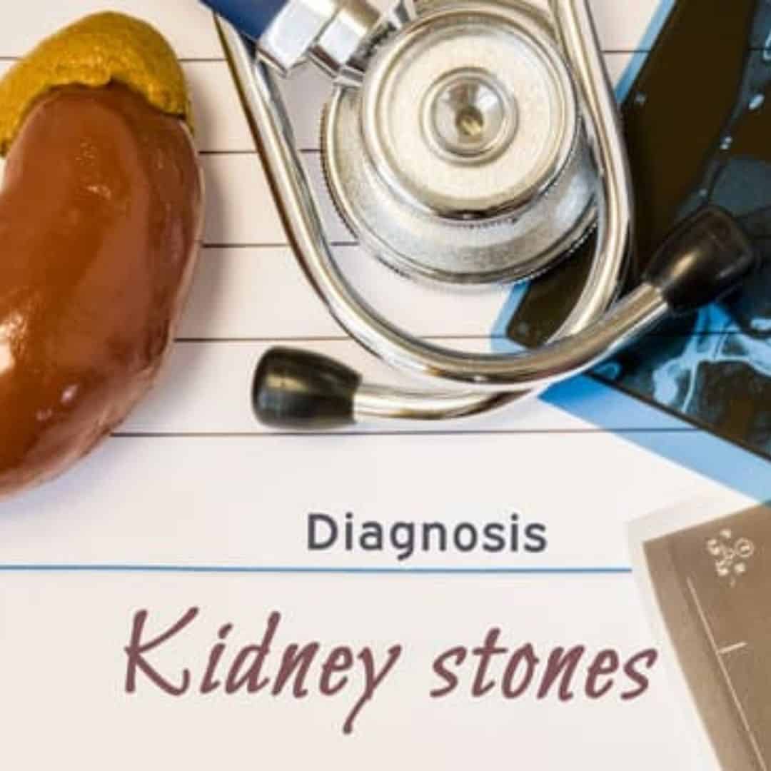 Kidney Stone Relief Symptoms, and Prevention Chronically Gina