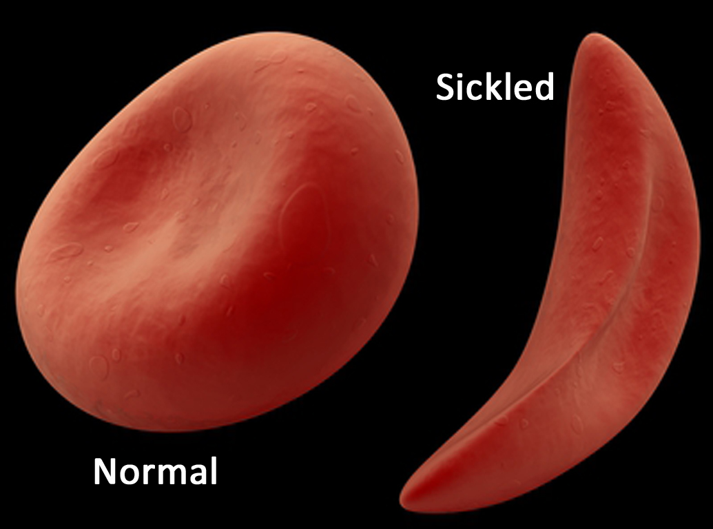 Sickle Cell hemoglobin v Normal Hemoglobin