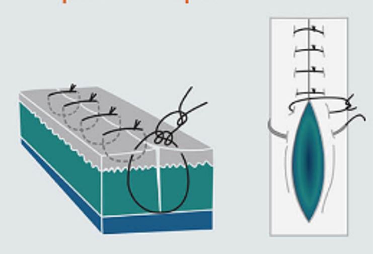 Les Sutures CHV SaintMartin