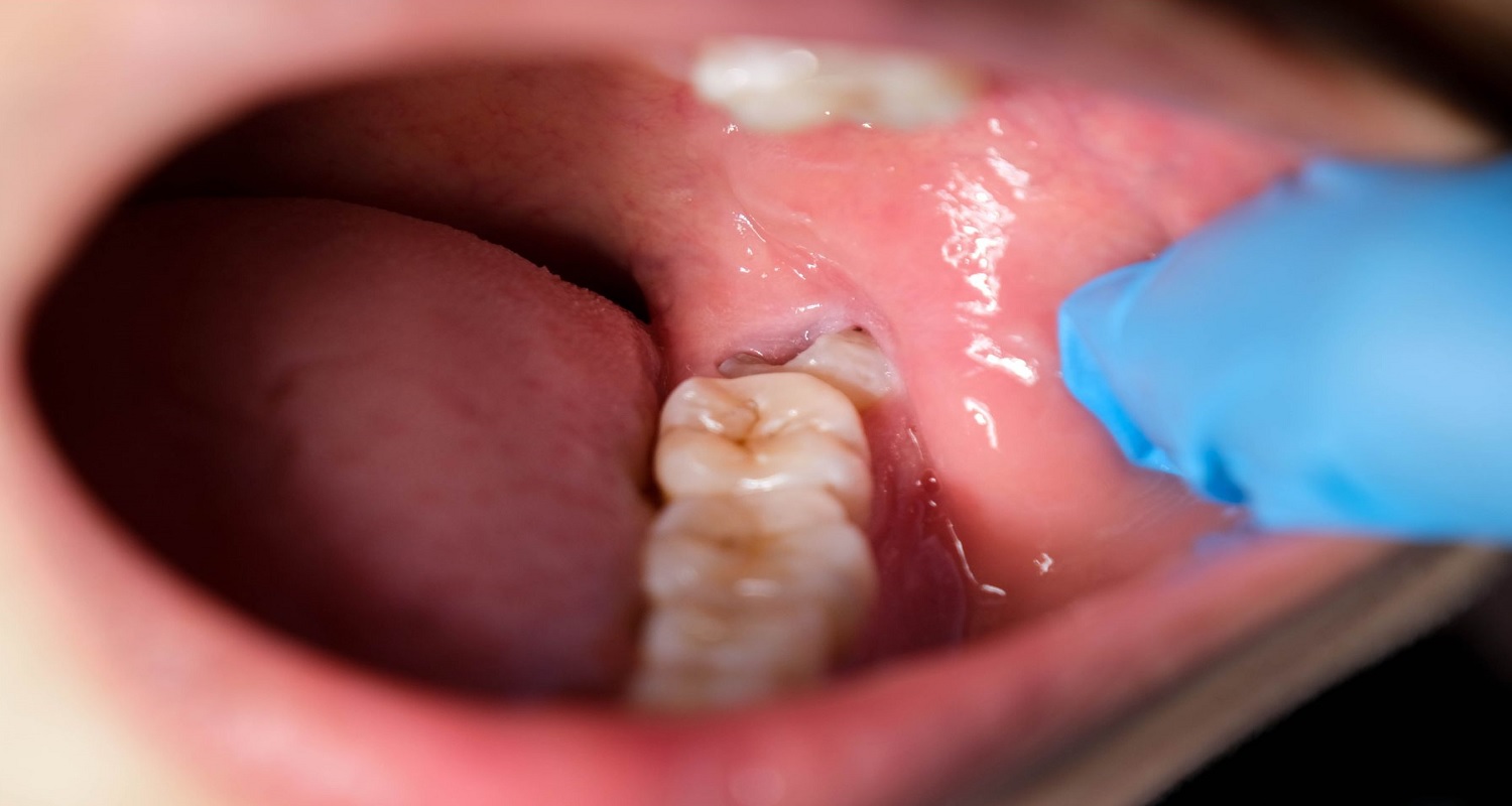 CiDentist Best Foods To Eat After Wisdom Teeth Removal