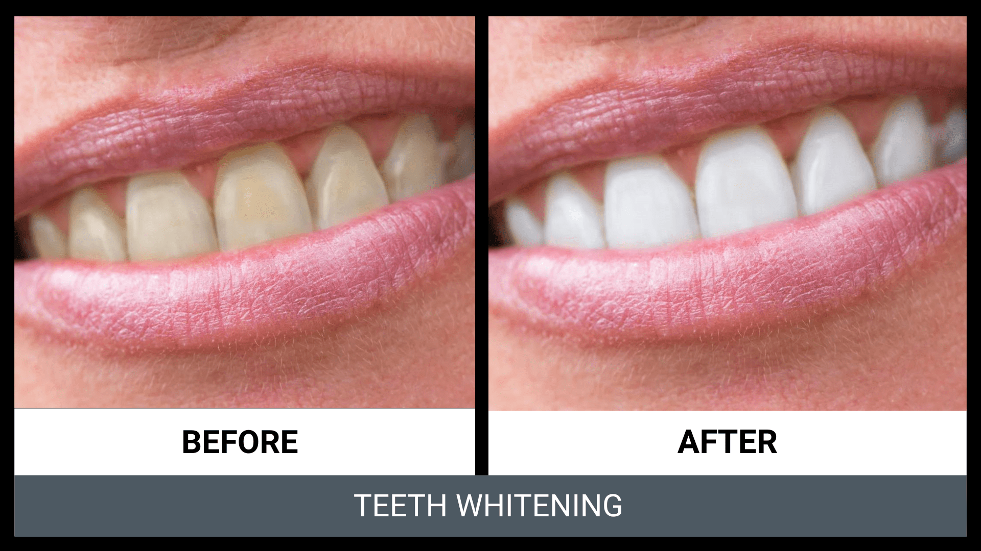 Zoom Teeth Whitening Channel Islands Family Dental Office Dentist