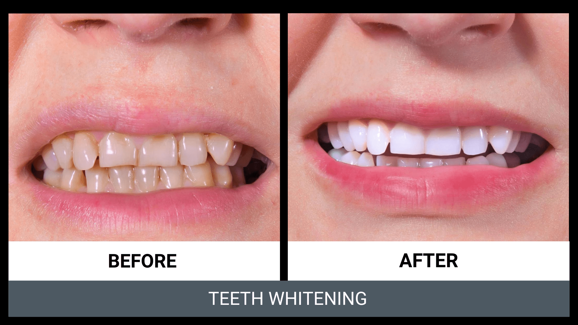 Zoom Teeth Whitening Channel Islands Family Dental Office Dentist