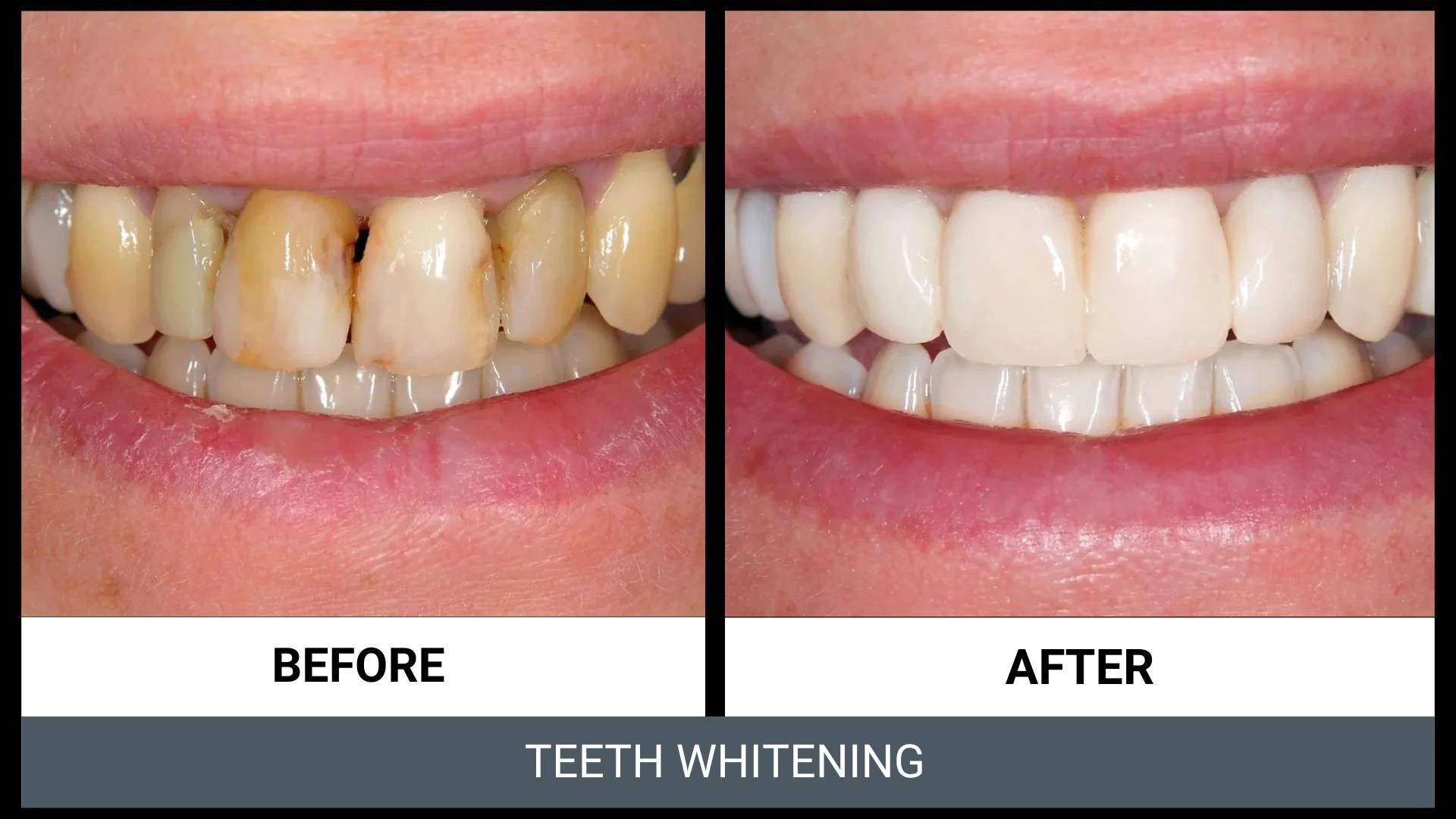 Zoom Teeth Whitening Channel Islands Family Dental Office Dentist