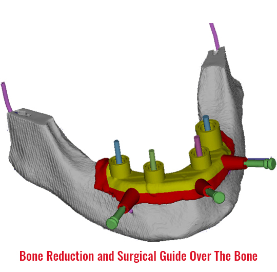 Customized Surgical Guides Cinzara The Center for Guided Surgery