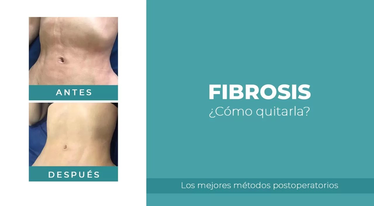 Quitar la fibrosis Los mejores métodos postoperatorios 2021 Quitar la fibrosis Los mejores métodos postoperatorios 2021