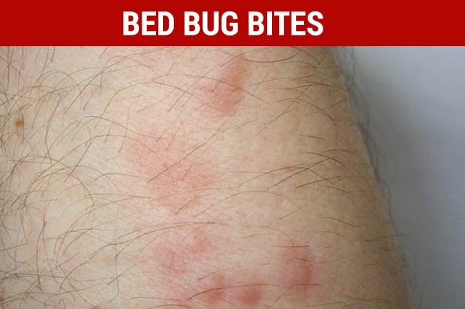 pictures of bed bug bites