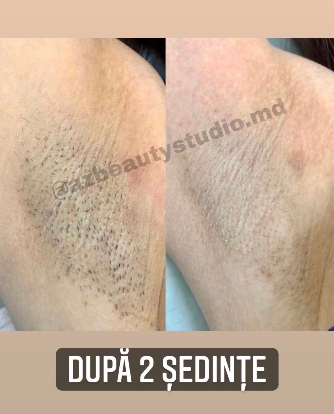 Epilare cu Laser Dioda zona gambe + genunchi + intim profund + axile la