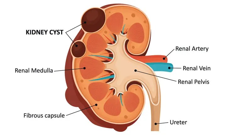 What are kidney cysts? - Chronic Kidney Disease Explained