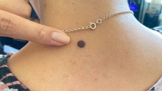 claves para detectar cáncer de piel a tiempo