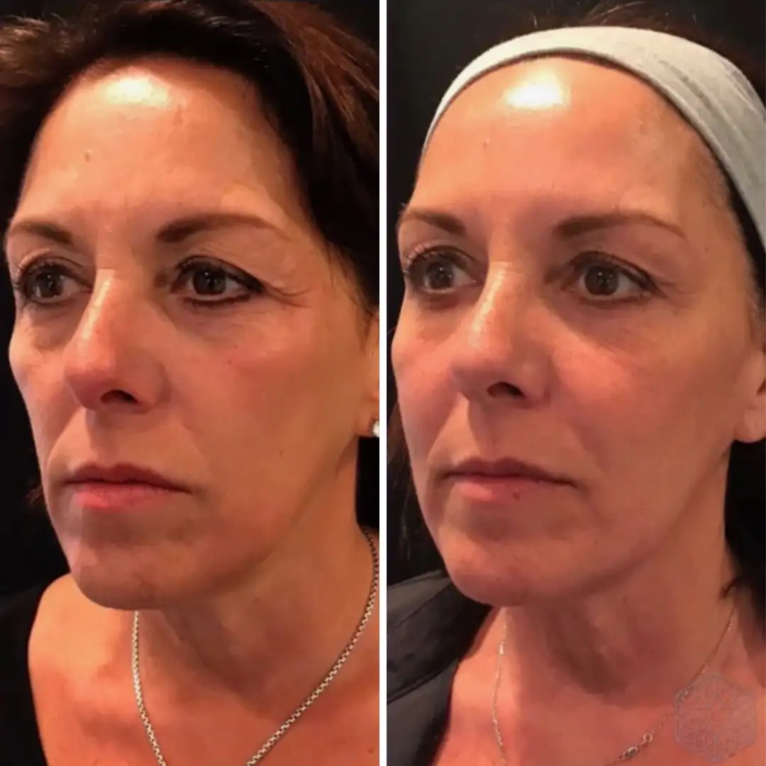 Why Everyone Is Talking About Sculptra Right Now Clarity Medical