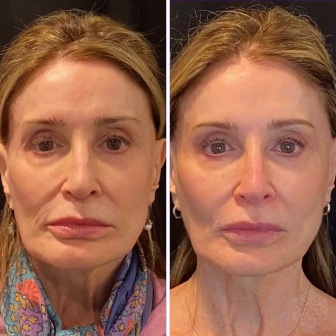 Why Everyone Is Talking About Sculptra Right Now Clarity Medical