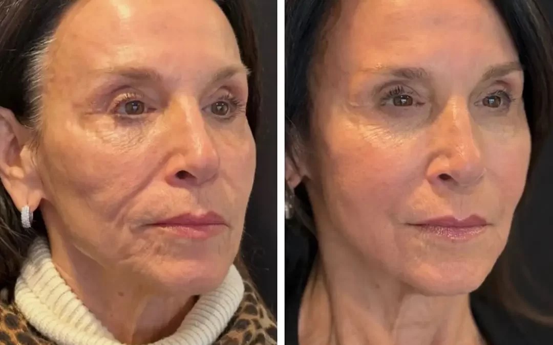 Why Everyone Is Talking About Sculptra Right Now Clarity Medical
