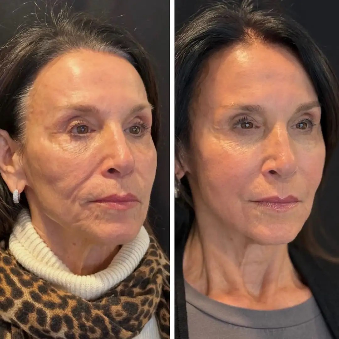 Why Everyone Is Talking About Sculptra Right Now Clarity Medical