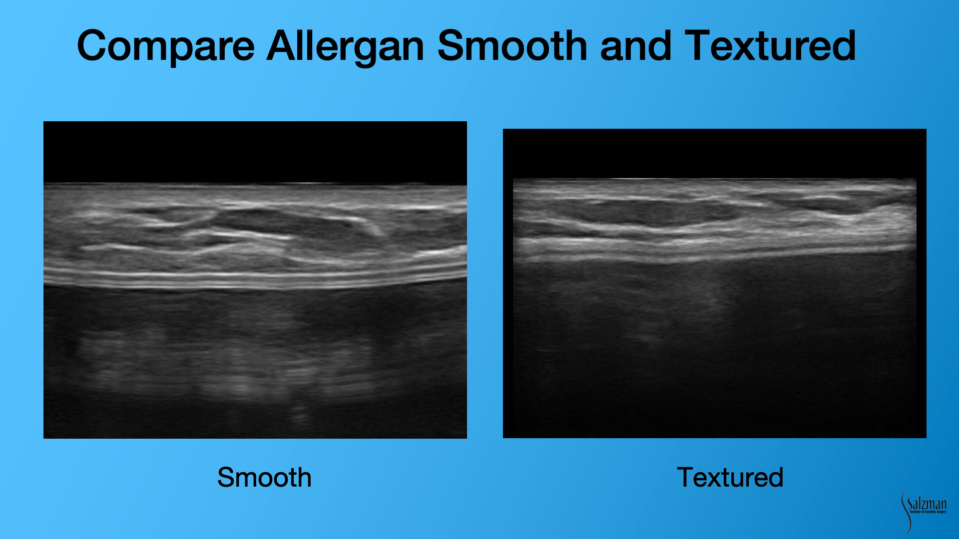 Handheld Ultrasound is Quick & Safe for the Surveillance of Silent