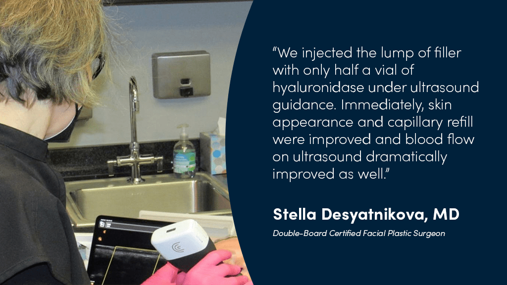 Dermal Filler Occlusion Dr. Stella to the Rescue with Clarius